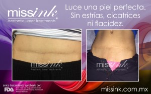 Missink eliminacion de arrugas y cicatrices